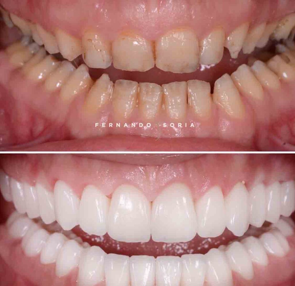 Antes y después clínica dental Madrid Fernando Soria - Uno de los mejores dentistas de Madrid
