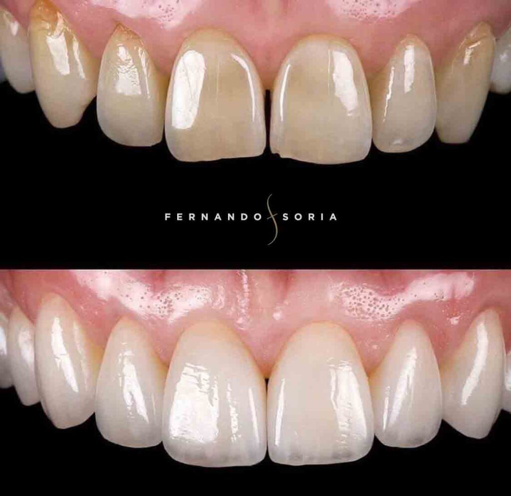 Antes y después clínica dental Madrid Fernando Soria - Uno de los mejores dentistas de Madrid