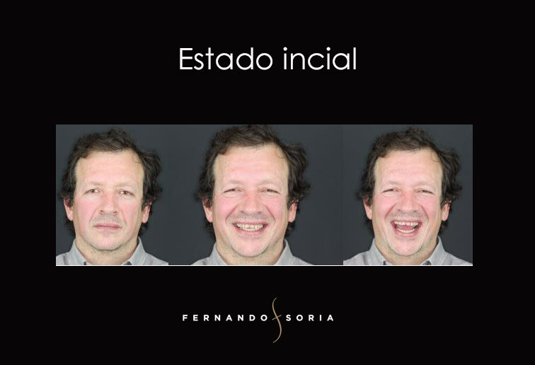 Diseño Digital de la Sonrisa - Clinica Dental Madrid Fernando Soria