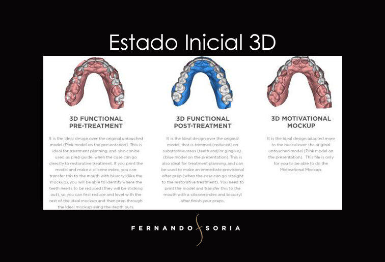 Diseño Digital de la Sonrisa - Clinica Dental Madrid Fernando Soria