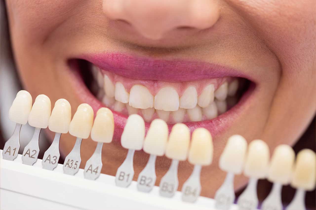 tipos carillas dentales clinica-dental