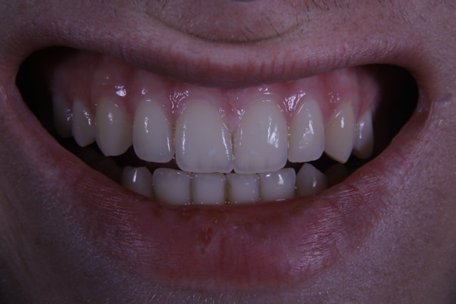 tipos de manchas en los dientes